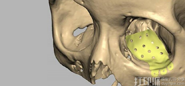 3D打印技術(shù)在醫(yī)療植入物研發(fā)與制造中有什么價(jià)值？