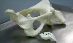 湖南医药学院第一附属医院3D打印完成人工全髋关节翻修术