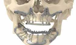 CADSkills开发出3D打印钛颌骨植入物 可减少术后恢复时间