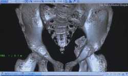 广州南医三院3D打印1:1骨盆骨折模型完成接骨手术