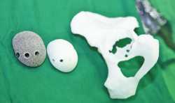 武进人民医院首次采用3D打印技术为髋关节患者进行置换手术