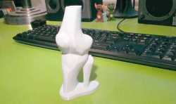 梅州市成功完成首例3D打印辅助人工膝关节置换手术