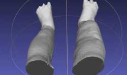 iPad 3D扫描仪帮助华盛顿大学科学家测量象皮病患者的腿肿胀