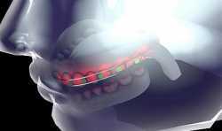 沙特研究人员开发出嵌入LED灯和无毒电池的智能3D打印牙套