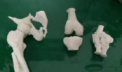 奉化区人民医院成功开展3例3D打印骨科模型手术