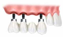 3D打印技术能在牙科种植牙中起到什么作用？