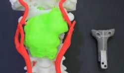 长征医院成功完成世界首例3D打印人工寰枢椎复合假体置换术