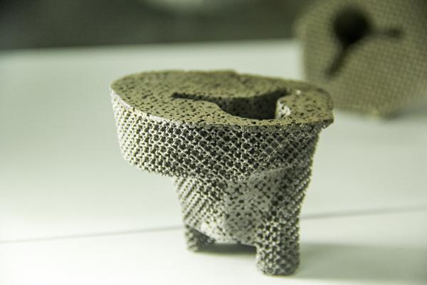 84岁老人接受全球首例3D打印钽金属垫块修复巨大骨缺损膝关节翻修手术
