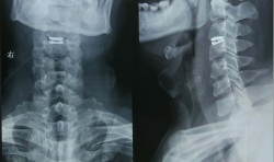 国内首例新型人工颈椎间盘置换手术在江西省人民医院成功完成