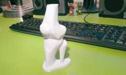 昆医附一院今年已实施11例3D打印置换人工膝关节手术