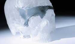 哈市第五医院成功应用3D打印完成一例复杂的颅骨成型术
