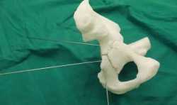 3D打印助力番禺区石碁人民医院骨科个性化治疗