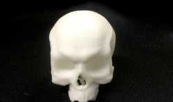 男婴患上万分之六的怪病 3D打印技术帮他重拼颅骨