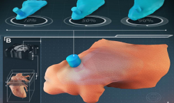 3D打印封堵器可以降低心房颤动患者引发血栓的风险
