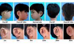 我国科学家们使用3D打印技术为小耳畸形儿童增加新的耳朵