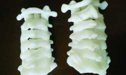 淮安首次运用3D打印技术完成最难脊柱肿瘤切除手术