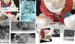 滨州医学院附属医院甲乳外科成功完成2例3D打印辅助下甲状旁腺手术