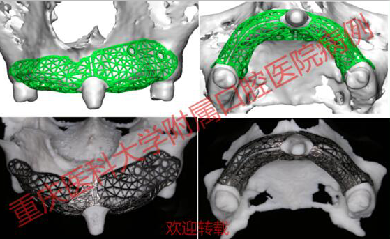 重医口腔医院成功完成全国首例3D打印个性化钛网修复大面积牙槽骨缺损病例