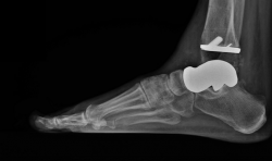 3D打印骨骼复制品帮助踝关节囊肿飞行员保持飞行高度