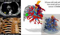 病患的福音！具有肿瘤的肺模型的混合3D打印减少了手术时间