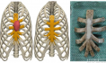 吉大一院胸外一科成功开展东北三省首例利用PEEK材料3D打印进行胸壁重建的手术