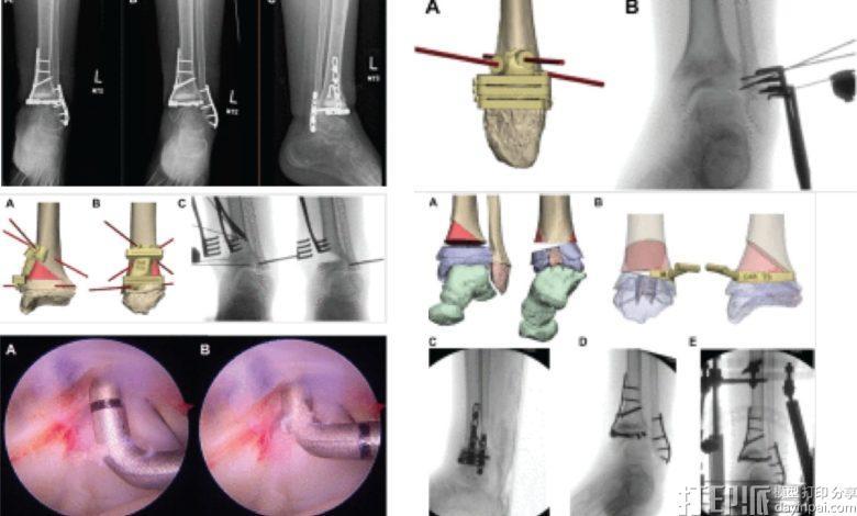 耶鲁医学院利用3D手术规划提升儿童骨科手术效果