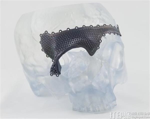 强生子公司在欧洲推出定制化3D打印颌面植入物.jpg