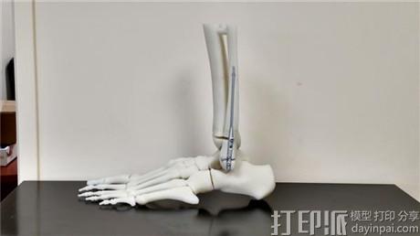 3D打印帮助Sonoma开发出更快速先进的骨折修复手术.jpg