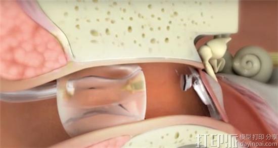 hearing-aid-specialist-earlens-adopts-3d-printing-improve-design-flexibility-5.jpg