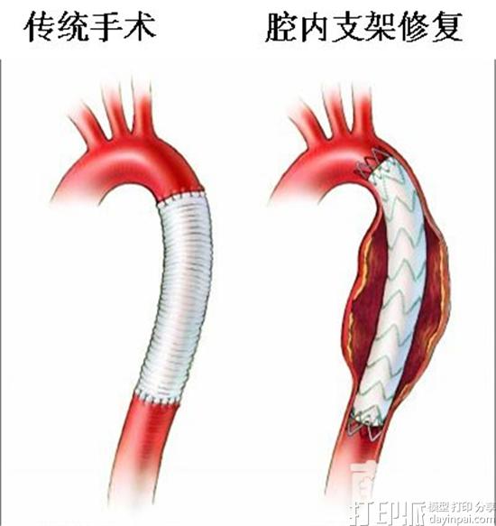 3D打印技术辅助F-EVAR治疗JR-AAA获初步应用成功.jpg