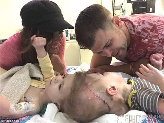 3d-printing-and-scanning-give-twins-conjoined-at-the-head-a-fighting-chance-3.jpg