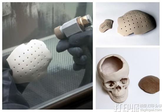 俄罗斯科学家开发出可被人体吸收的3D打印聚合物颅骨植入物.jpg