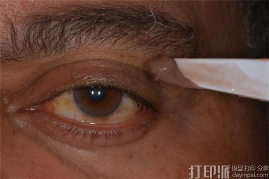 cancer-survivor-gets-worlds-first-3d-printed-face-made-using-a-smartphone-5.jpg