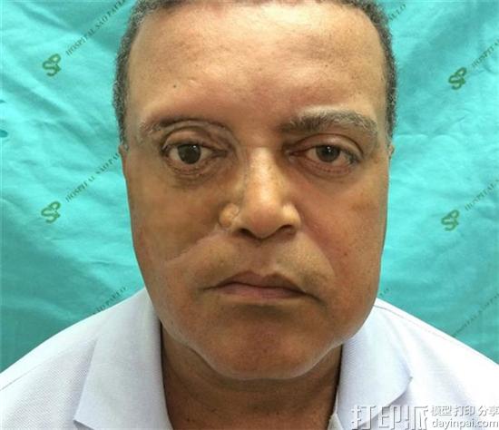 cancer-survivor-gets-worlds-first-3d-printed-face-made-using-a-smartphone-8.jpg
