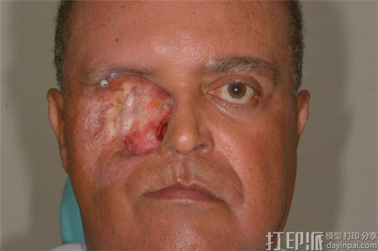 cancer-survivor-gets-worlds-first-3d-printed-face-made-using-a-smartphone-2.jpg