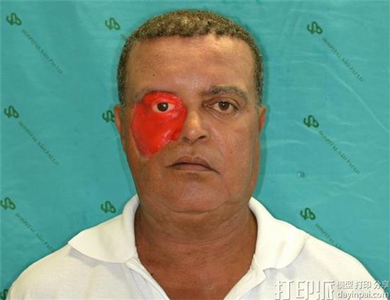 cancer-survivor-gets-worlds-first-3d-printed-face-made-using-a-smartphone-4.jpg
