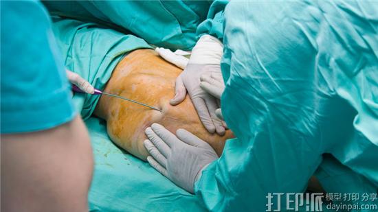 Liposuction.jpg