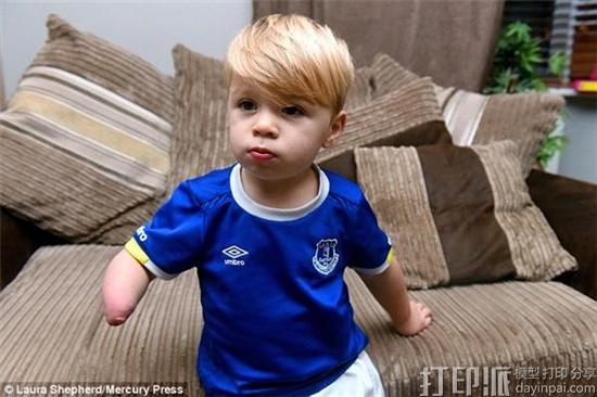 two-year-old-everton-fan-kobi-receives-3d-printed-arm-emblazoned-with-team-logo-5.jpg