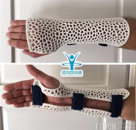waspmedical-is-revolutionizing-scoliosis-treatment-with-3d-printing-7.jpg