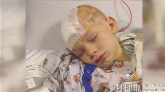 3D-printed-skull-gives-young-boy-second-chance-life-1.jpg