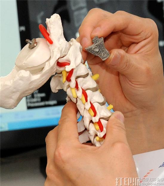 3D打印脊椎植入物是怎样打印的？能和人体骨骼相融合吗？.jpg