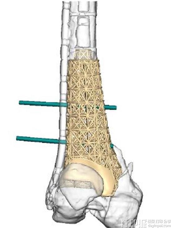 australian-surfer-back-water-after-3d-printed-titanium-implant-saves-leg-2.jpg