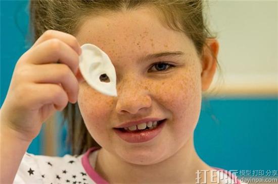 爱丁堡医院用3D打印为九岁女孩制作出一个新耳朵 恢复其听力.jpg
