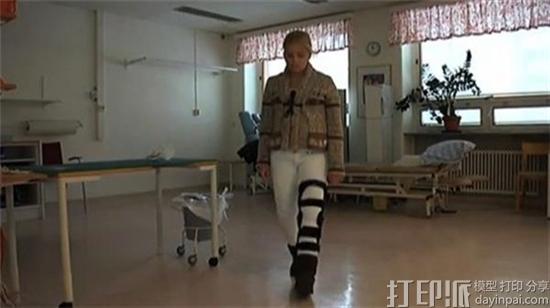 3D打印髋关节植入物让瑞典16岁少女重新直立行走