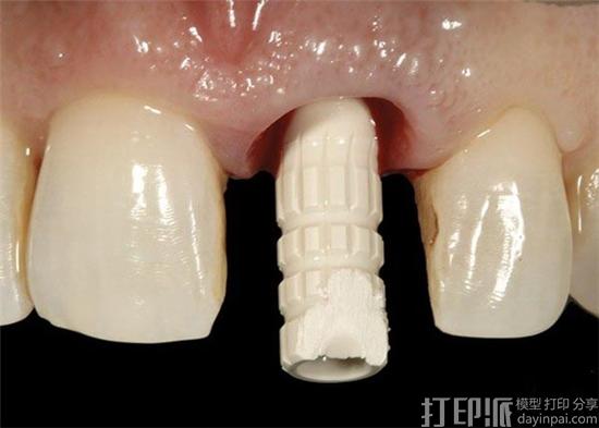 PEEK材料的医用人体植入物是怎么3D打印出来的？