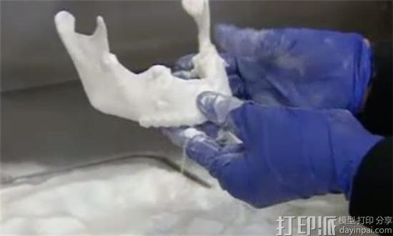英国医生团队借3D打印技术为车祸伤者重新创建下颌