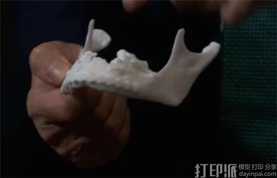 英国医生团队借3D打印技术为车祸伤者重新创建下颌