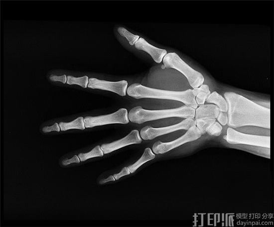 得益于3D打印支架 休斯敦莱斯大学科学家在骨癌研究上取得新进展