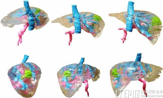 波兰研究员花150美元用FDM技术3D打印出一个术前肝脏模型