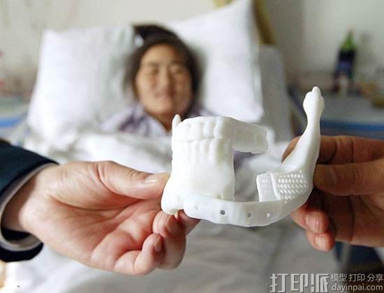 3D打印骨科植入物市场中有哪几家做得好的公司？